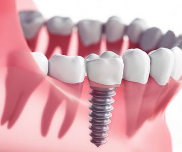 dental implants Oak Ridge
