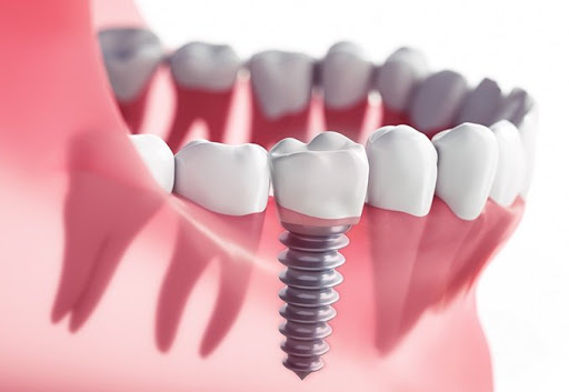 dental implants Oak Ridge