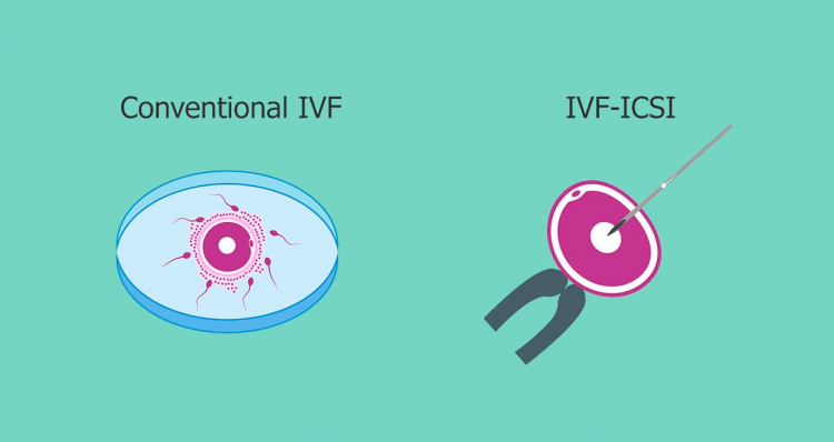 IVF cost in South Africa