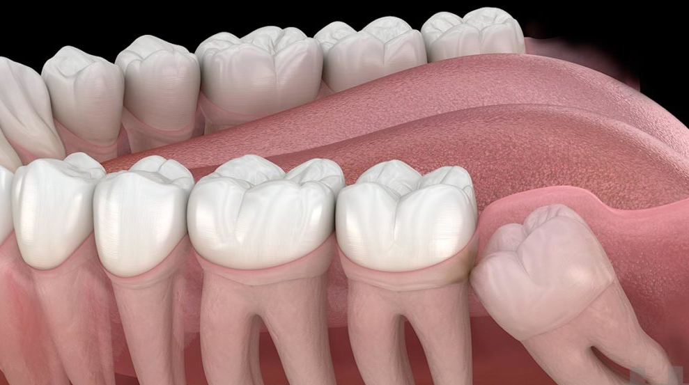 wisdom teeth removal Liverpool