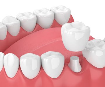 dental crowns