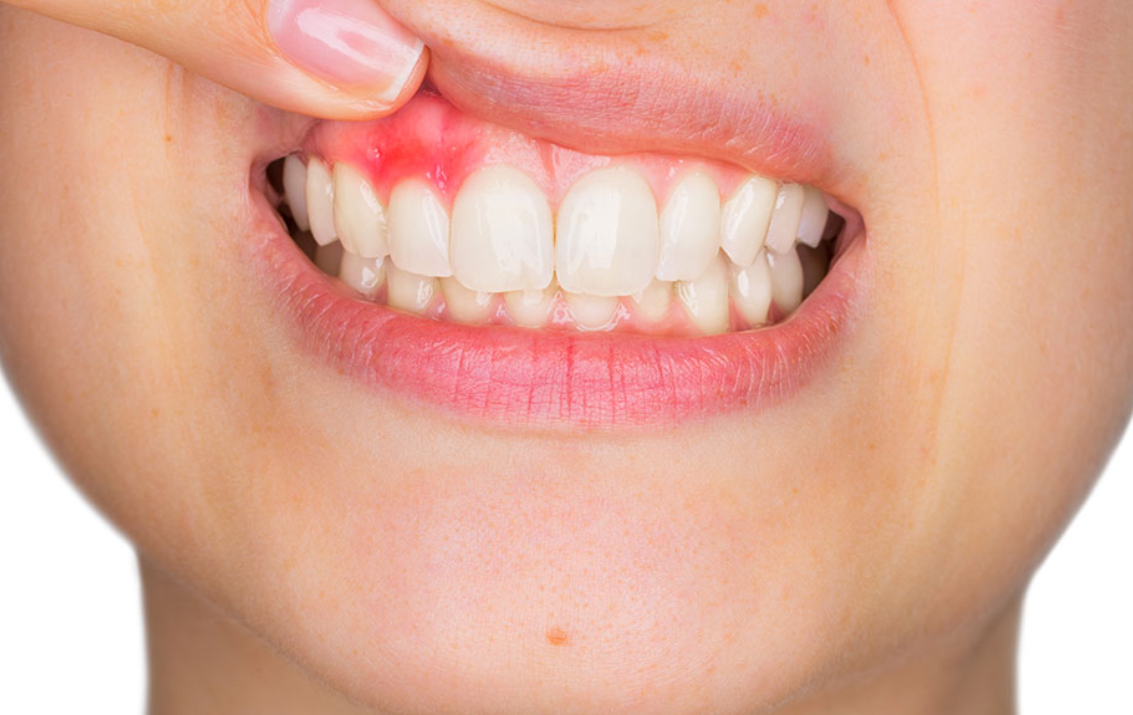 Dental implant infection signs