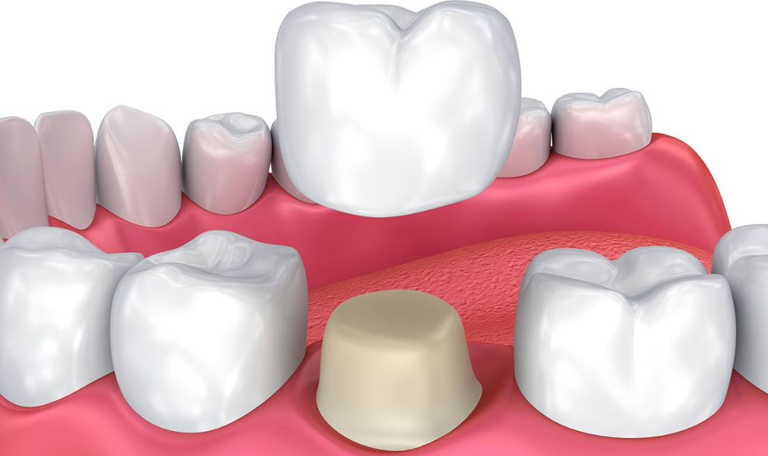 Dental crowns in the Gold Coast