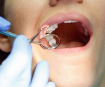 wisdom teeth removal recovery