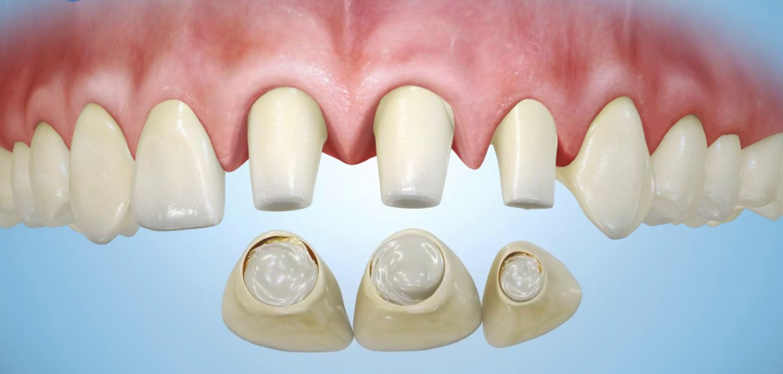 Porcelain dental veneers