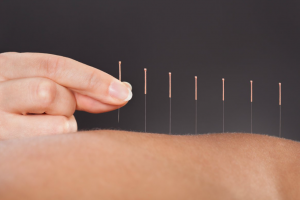 acupuncture in Wellington