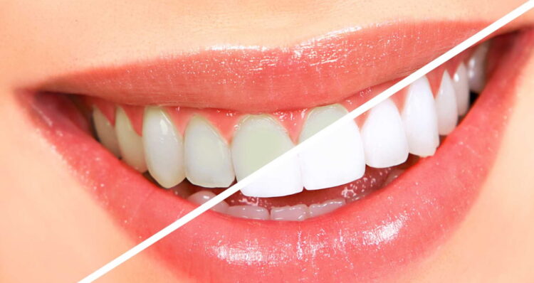 best teeth whitening