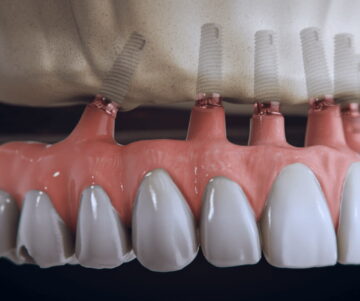 dental implant infection symptoms