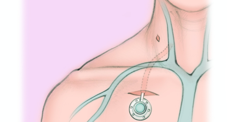 chemo port insertion