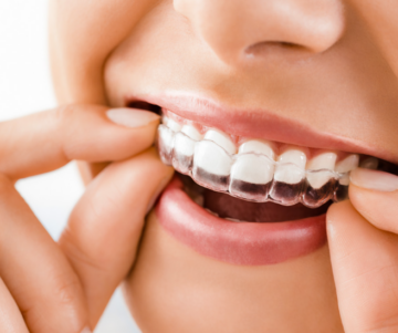 Invisalign treatment