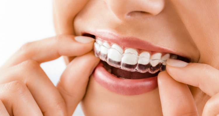 Invisalign treatment
