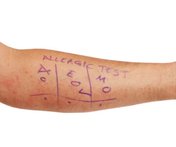 penicillin allergy testing