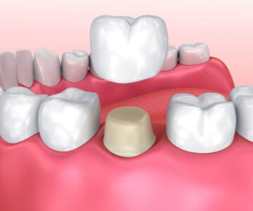 dental crowns