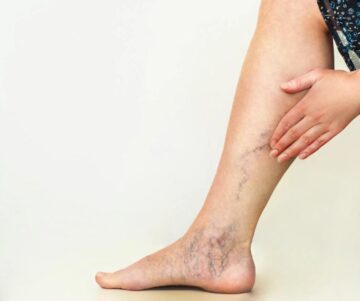 varicose sclerotherapy