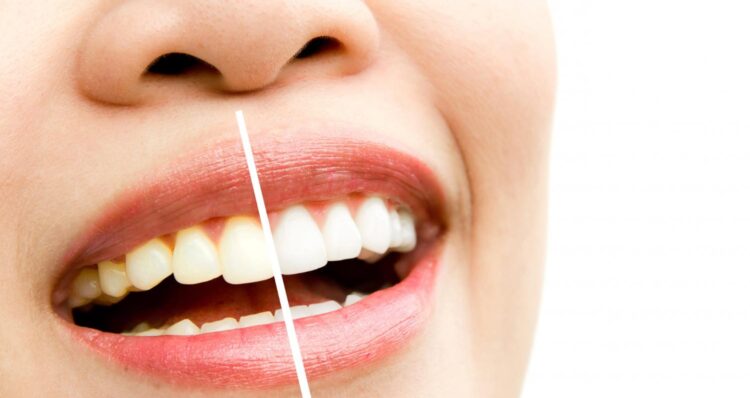 Teeth Whitening