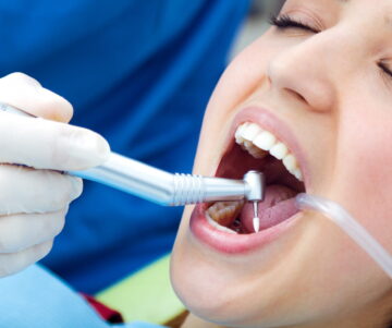 Teeth Polishing in Ballina