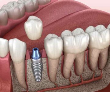 Hughson Dental Implants