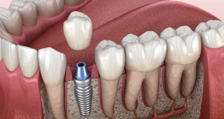 Hughson Dental Implants