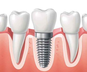 Hughson Dental Implants