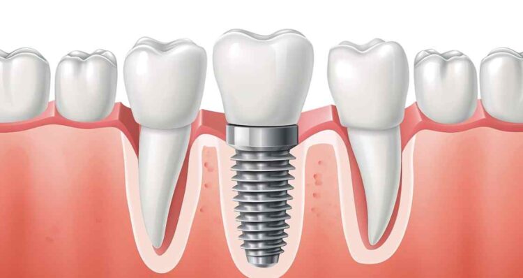 Hughson Dental Implants